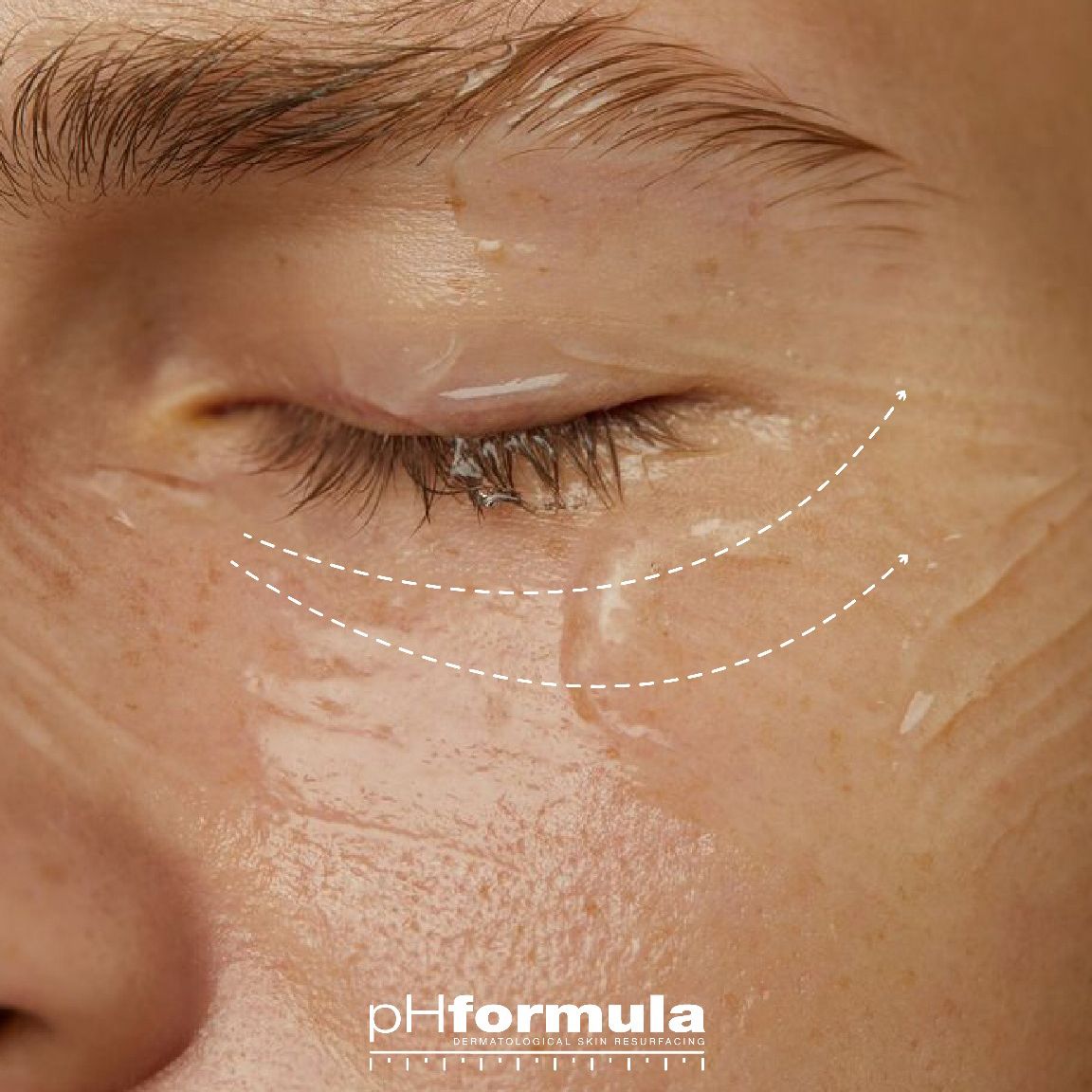 pHformula paakių procedūra