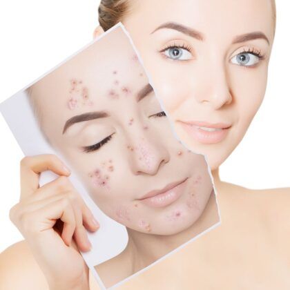 Gydomoji kosmetika aknės gydymui