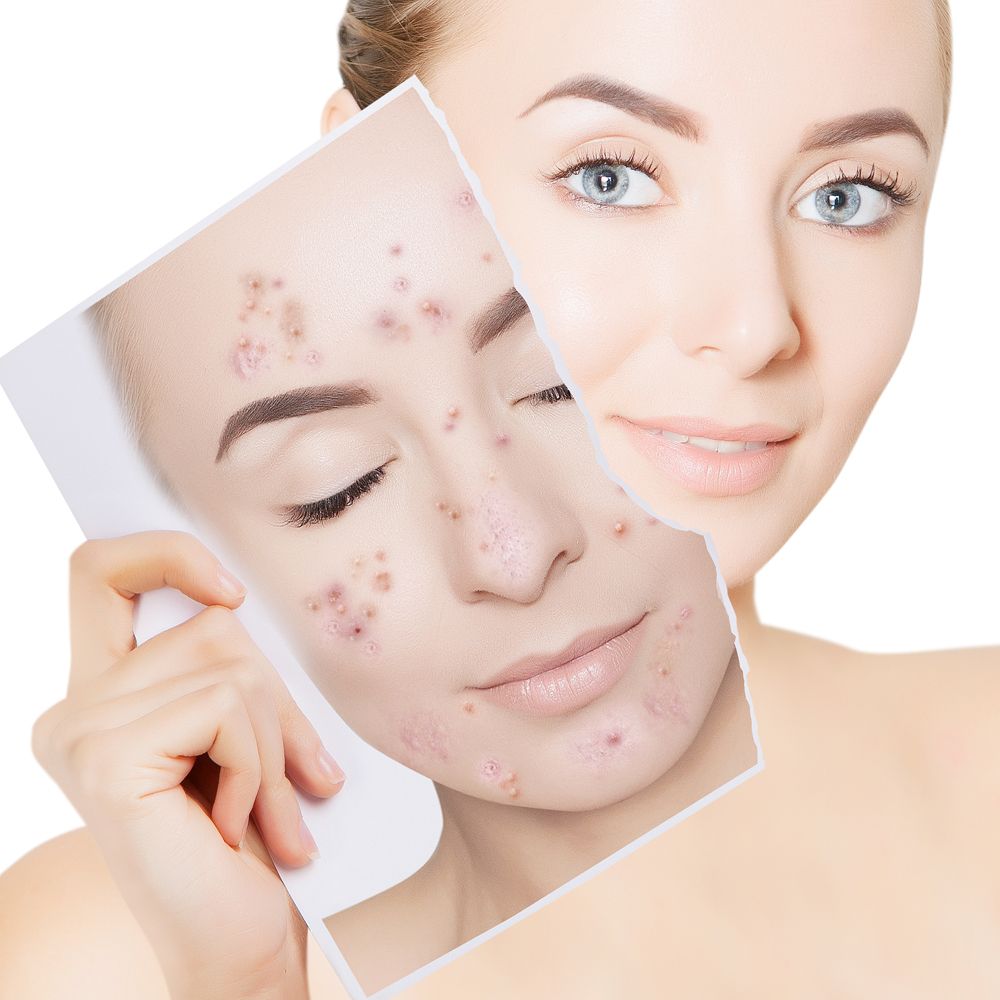 Sunki aknė/hormoninė aknė ( LIC salicilio sistema )