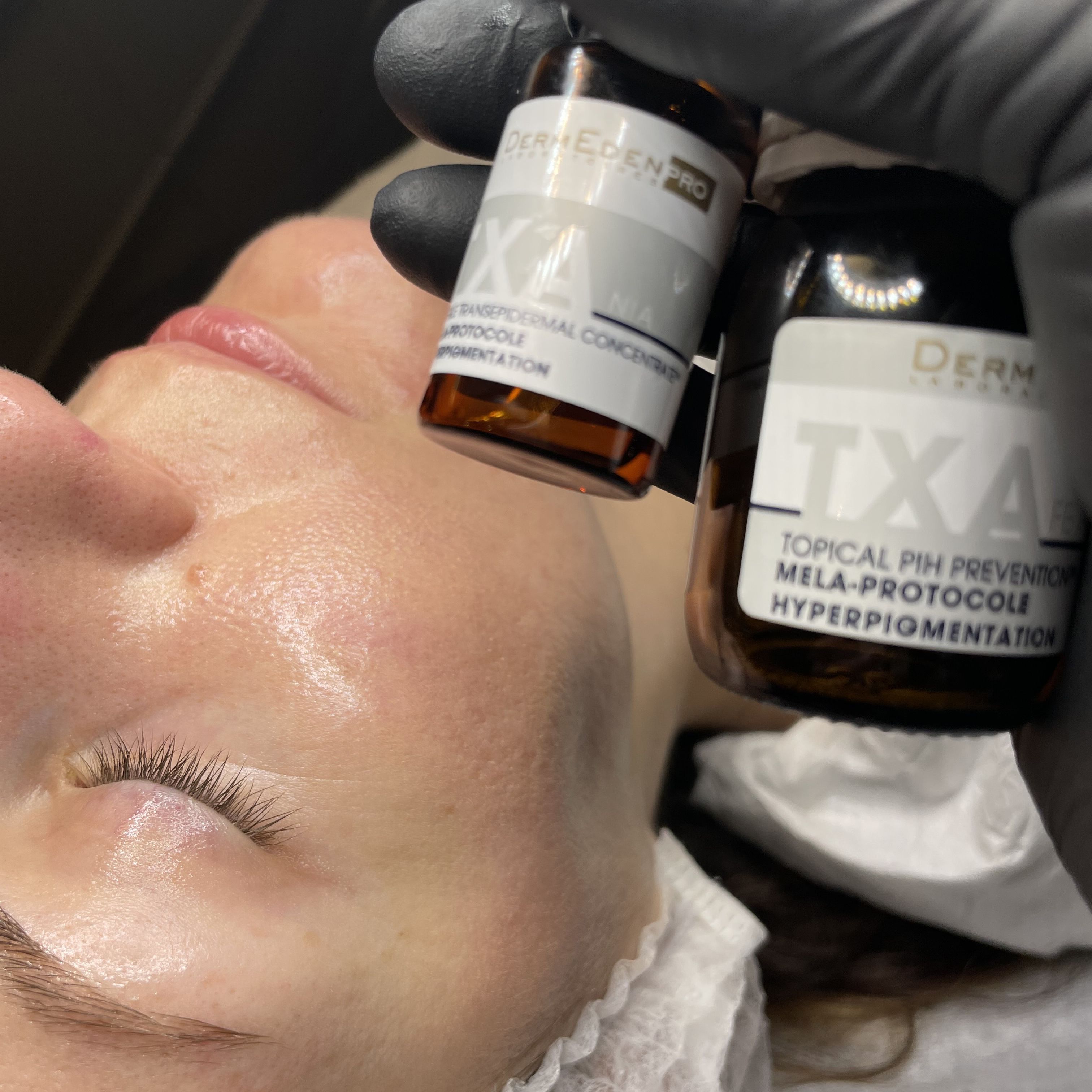 Dermeden TXA procedūra pigmentacijos mažinimui